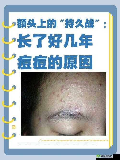 痘痘的烦恼与自我救赎，一场肌肤的战役